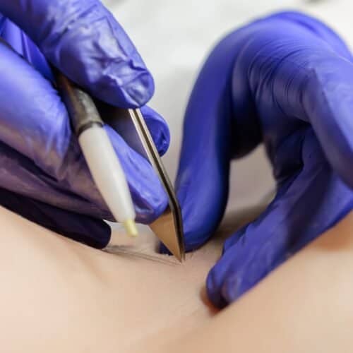 Electrolysis
