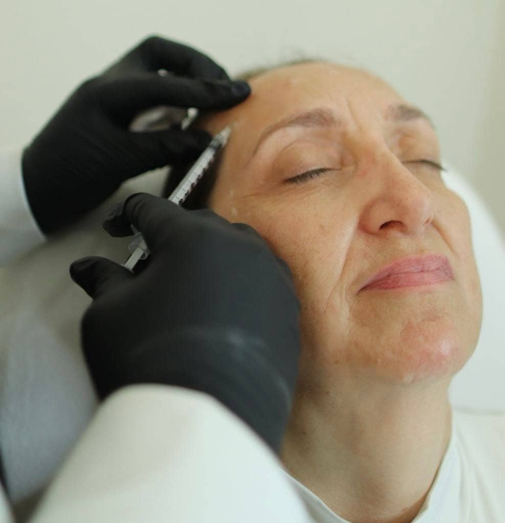 Botox - Neuromodulator for facial lines