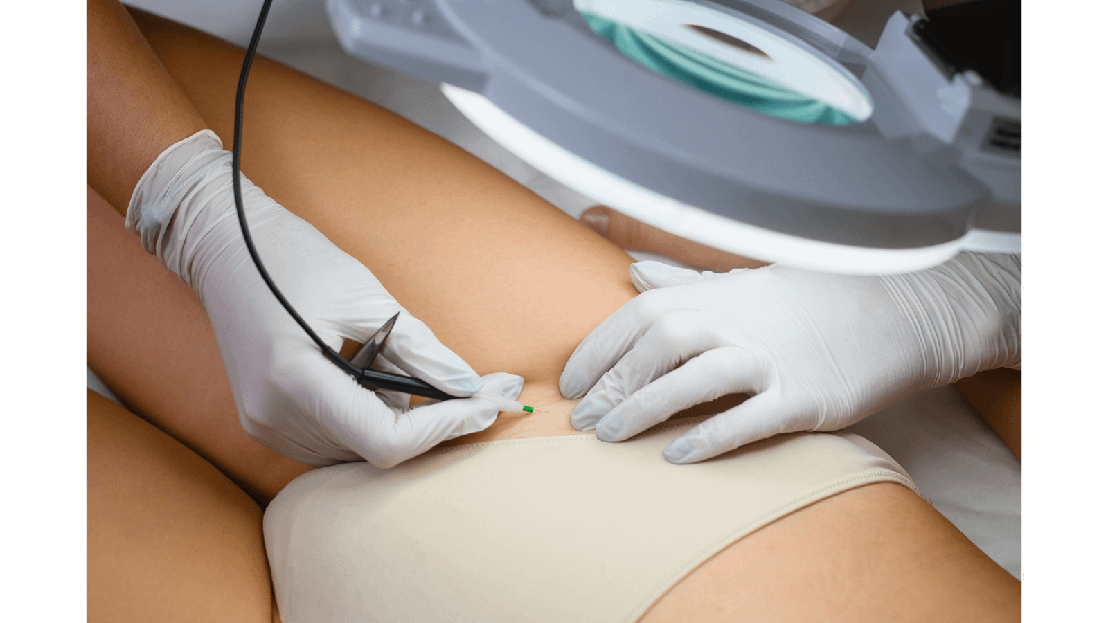 Is Electrolysis Right for You?